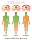 Medical illustration Of Types Of Cerebral Palsy Royalty Free Stock Photo