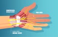 Vector of a carpal tunnel syndrome with median nerve compression Royalty Free Stock Photo