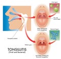 Medical Illustration Of Viral And Bacterial Tonsillitis Royalty Free Stock Photo