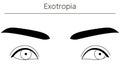 Medical illustrations, diagrammatic line drawings of eye diseases, strabismus and exotropia