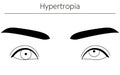 Medical illustrations, diagrammatic line drawings of eye diseases, strabismus and hypertropia