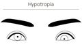 Medical illustrations, diagrammatic line drawings of eye diseases, strabismus and hypotropia