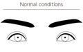 Medical illustrations, diagrammatic line drawings of eye diseases, strabismus and normal conditions