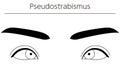 Medical illustrations, diagrammatic line drawings of eye diseases, strabismus and pseudostrabismus