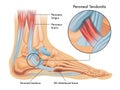 Medical illustrations of symptoms of peroneal tendonitis Royalty Free Stock Photo