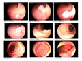 Medical image Gastrointestinal endoscopic examination image Royalty Free Stock Photo
