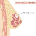 Medical Infographic Cross Section of Female Breast with Fibroadenoma. Information card with benign breast lesion