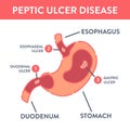 Medical infographics with types of peptic ulcer stomach disease