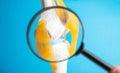 Medical mockup of a knee joint under a magnifying glass on a blue background. Knee ligament rupture and sprain concept