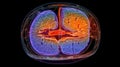 A medical, MRI image of the brain, showing a cross - section with detailed annotations. Magnetic Resonance Imaging