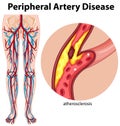 Medical peripheral artery disease Royalty Free Stock Photo