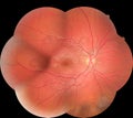 Medical photo retina diabetic retinopathy. Examination of the eye, diabetic retinopathy, ARMD