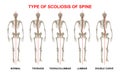 Medical poster demonstrating types of scoliosis on white background. Illustration of healthy and diseased spine