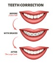 Medical poster showing a teeth correction process. Vector illustration depicting human smile, teeth and dental braces.