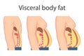 Abdominal fat surrounds the inner doors of the abdominal cavity. Overweight disease concept. Weight loss, liposuction, and diet