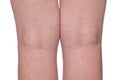 Medical problem - varicose veins, female legs close up on a white Royalty Free Stock Photo