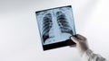 A medical professional holds an X-ray of the lungs a doctor examines pneumonia