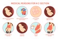 Medical reasons for cesarean delivery or c-section. Royalty Free Stock Photo