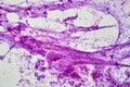 Transbronchial lung brushing of Cryptogenic Organizing Pneumonia