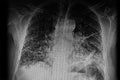X- Ray image: Multiple small bilateral nodular lesions and spiculated image on the left lung.