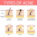 Medical vector illustration of different types of acne on human skin. Appearance of pimples in hair follicle