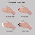 Medical vector illustration. Frostbite stages. Blue and red frostbitten fingers. Stages of hypothermia in cold season