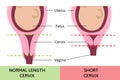 Medical vector illustration about normal and short cervix. Pregnancy problem. Child in womb or uterus. Danger