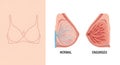 Comparative diagram illustrates normal versus excised breast tissue anatomy illustration Royalty Free Stock Photo