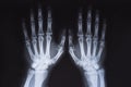 Medical x ray hands image Royalty Free Stock Photo