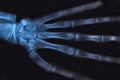 Medical x-ray image of human hand. Radiology diagnostic of skeleton bones Royalty Free Stock Photo