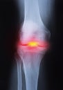 Medical x-ray knee joint image with arthritis Royalty Free Stock Photo