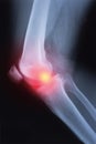 Medical x-ray knee joint image with arthritis Royalty Free Stock Photo