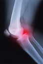 Medical x-ray knee joint image with arthritis Royalty Free Stock Photo