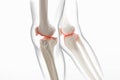 Medically accurate representation of an arthritic knee joint, knee meniscus, human leg, 3d illustration