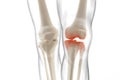 Medically accurate representation of an arthritic knee joint, knee meniscus, human leg, 3d illustration