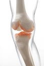 Medically accurate representation of an arthritic knee joint, knee meniscus, human leg, 3d illustration