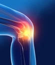 Painful osteoarthritic knee joint, medically 3D illustration