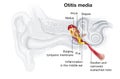 Inflammation of the middle ear, otitis media, medically illustration