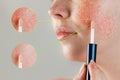 Medicine and cosmetology. Female cheek with rosacea close-up, with cosmetic Foundation on the brush near the skin. Close-up of the