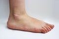 Medicine, flat feet, tarsoptosia, foot female isolated Royalty Free Stock Photo