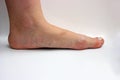 Medicine, flat feet, tarsoptosia, foot female isolated