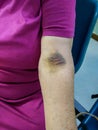 Medicine. Large hematoma on the left arm of an elderly woman caused by the rupture of a vein