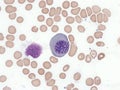 Megaloblastic anemia, bone marrow. Royalty Free Stock Photo