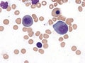 Megaloblastic anemia, bone marrow. Royalty Free Stock Photo