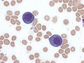 Megaloblastic anemia, bone marrow. Royalty Free Stock Photo