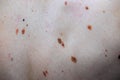 Melanocytic nevus, some of them dyplastic or atypical, on a caucasian man of 36 years old Royalty Free Stock Photo