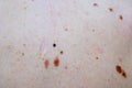 Melanocytic nevus, some of them dyplastic or atypical, on a caucasian man of 36 years old