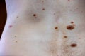 Melanocytic nevus, some of them dyplastic or atypical, on a caucasian man of 36 years old Royalty Free Stock Photo