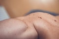 Melanocytic nevus, some of them dyplastic or atypical, on a caucasian man of 37 years old from Spain Royalty Free Stock Photo