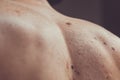 Melanocytic nevus, some of them dyplastic or atypical, on a caucasian man of 37 years old from Spain Royalty Free Stock Photo